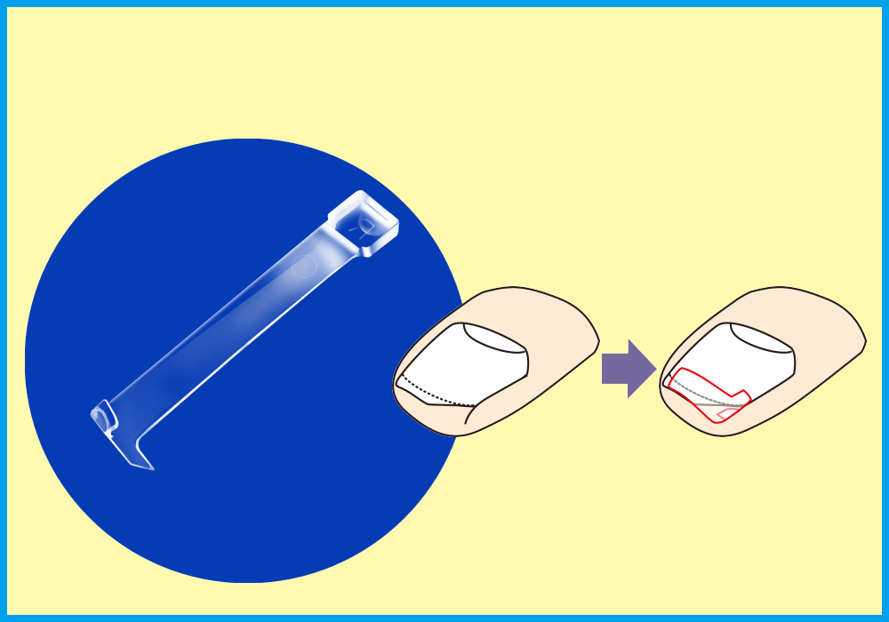 割れ爪、匙状爪の補正方法の画像
