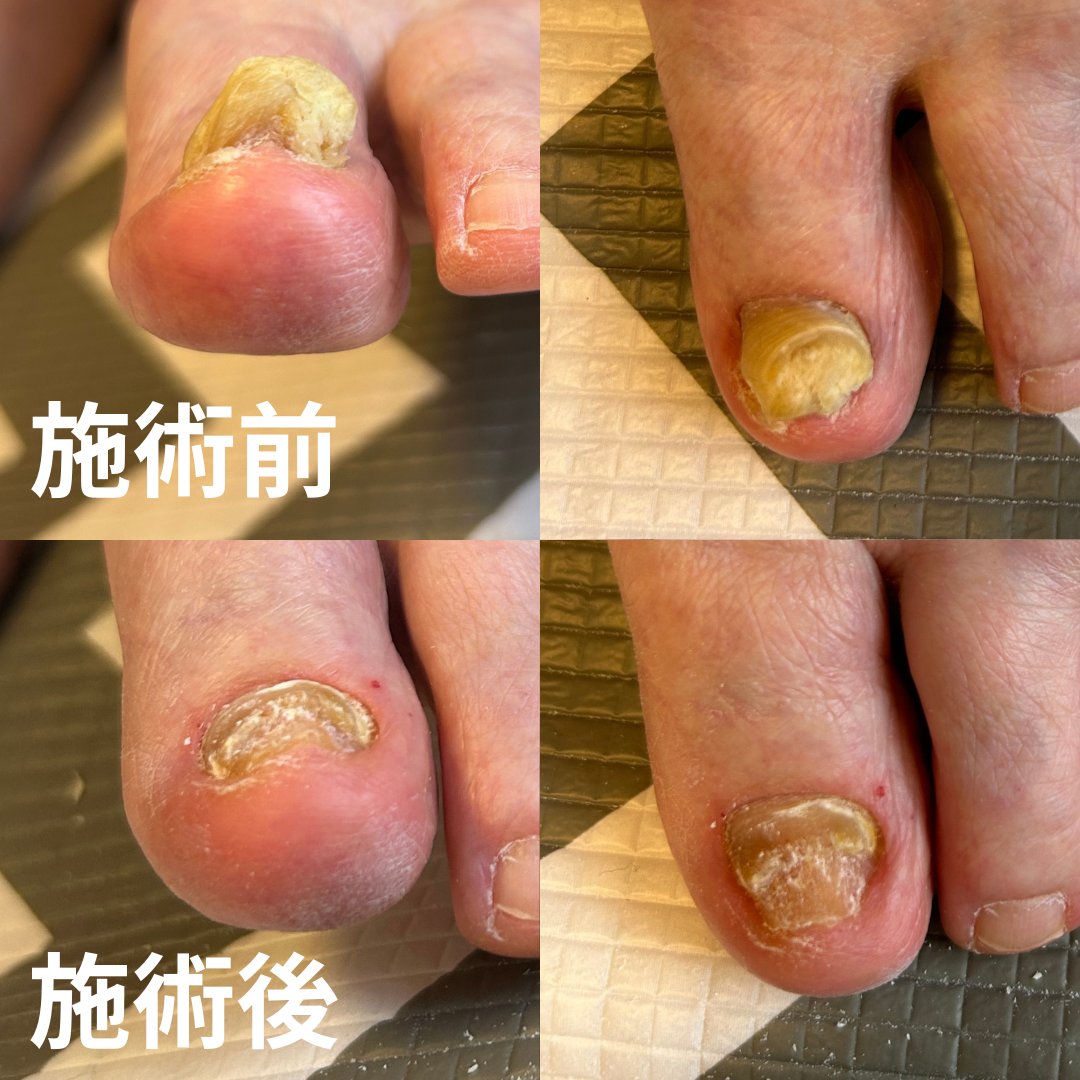 爪白癬治療後に残った肥厚爪のフットケア施術前後